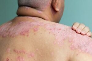 pernambuco-registra-mais-de-1.500-casos-de-hanseniase-em-2024