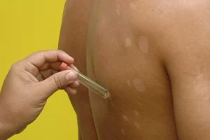 pernambuco-registra-mais-de-1.500-casos-de-hanseniase-em-2024