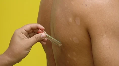 pernambuco-registra-mais-de-1.500-casos-de-hanseniase-em-2024