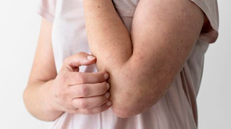 sintomas-e-cuidados-no-combate-a-hanseniase-em-st-e-regiao-na-tv-farol