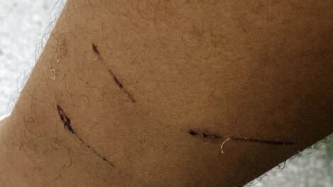 mulher-sofre-ataque-brutal-de-caes-em-serra-talhada-e-cobra-medidas