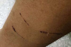 mulher-sofre-ataque-brutal-de-caes-em-serra-talhada-e-cobra-medidas