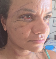 mulher-que-levou-61-socos-mostra-rosto-em-recuperacao